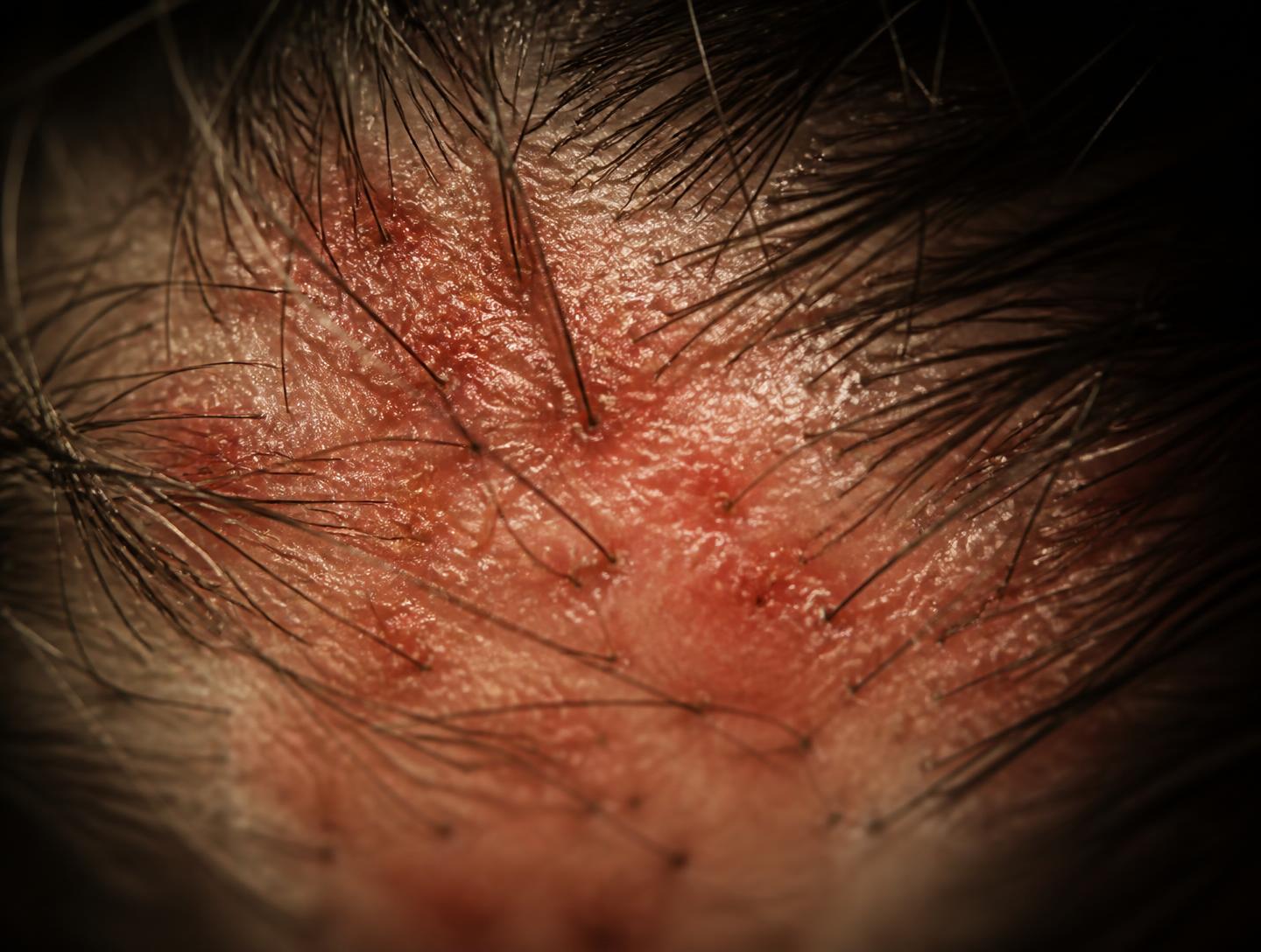 Flaking, itching, tenderness: rarely harmless