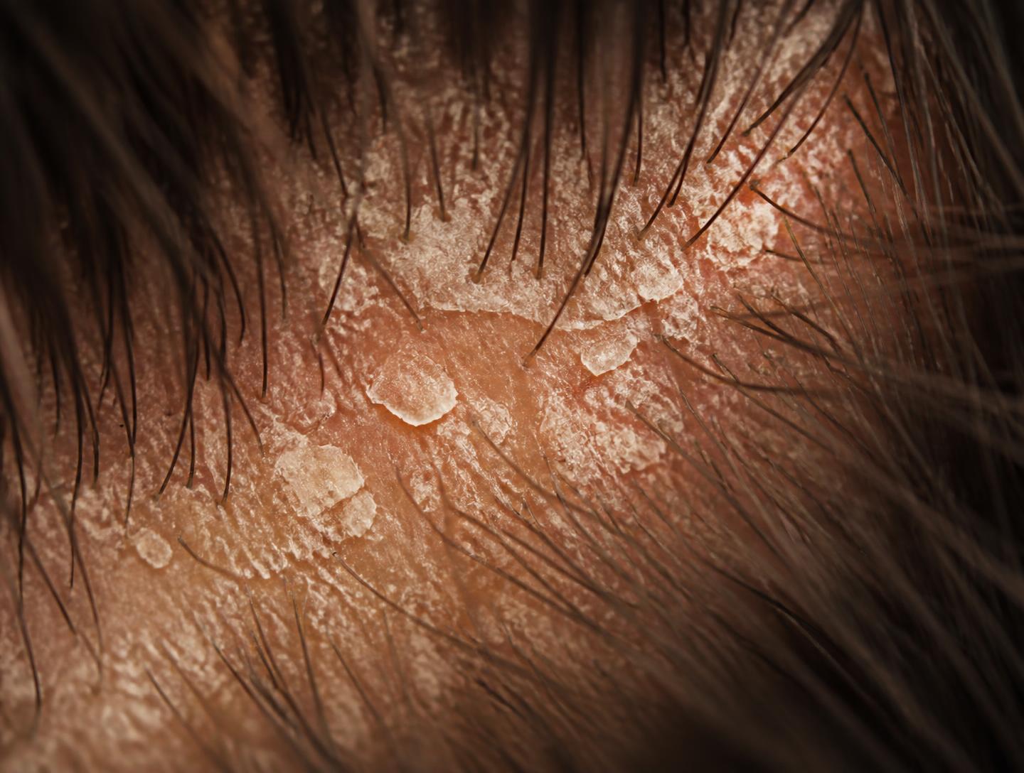 The quiet life happening on your scalp